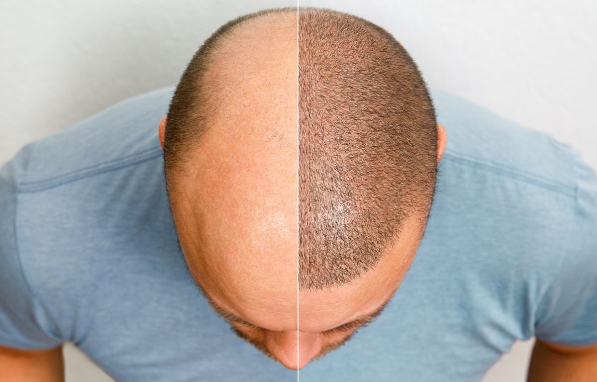 hairloss blocker
