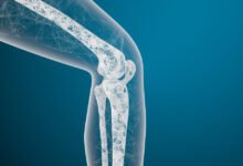 osteoporose